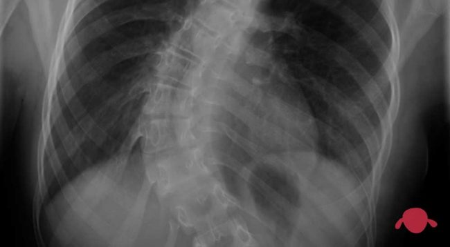 escoliosis-adolescente-portada-idiopatica-comienzo-tardio-deformidad-columna-traumatologia-infantil-juan-cabello
