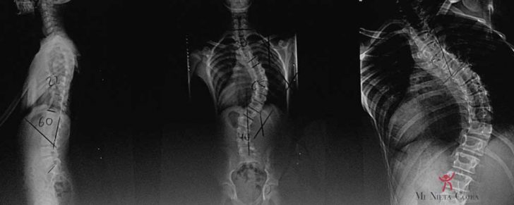 escoliosis-portada-deformidad-columna-escoliotica-traumatologia-infantil-juan-cabello