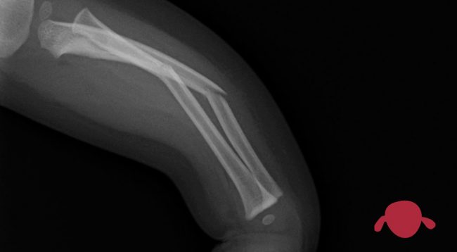 portada-afecta-fractura-crecimiento-fisis-traumatologo-infantil-juan-cabello