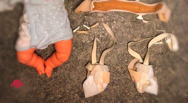 portada-arnes-pavlik-paulik-pauli-displasia-cadera-traumatologo-infantil-juan-cabello