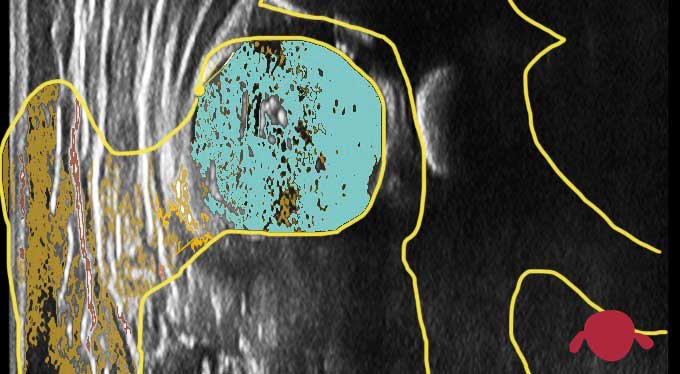 portada-eco-cadera-minietacojea-juan-cabello-traumatologo-infantil