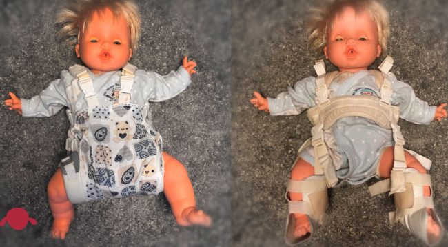 portada-pavlik-frejka-know-how-displasia-cadera-neonatal-traumatologo-infantil-juan-cabello