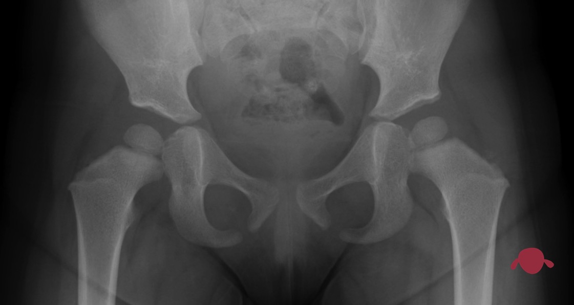 portada-quien-es-quien-cadera-infantil-femur-cuenco-displasia-cadera-traumatologo-infantil-juan-cabello jpg