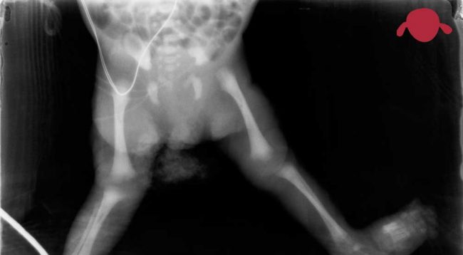 portada-traumatologia-infantil-porque-esqueleto-prematuro-traumatologo-ninios-adolescentes-juan-cabello1