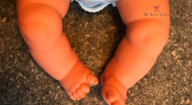 Torsión tibial interna - Juan Cabello