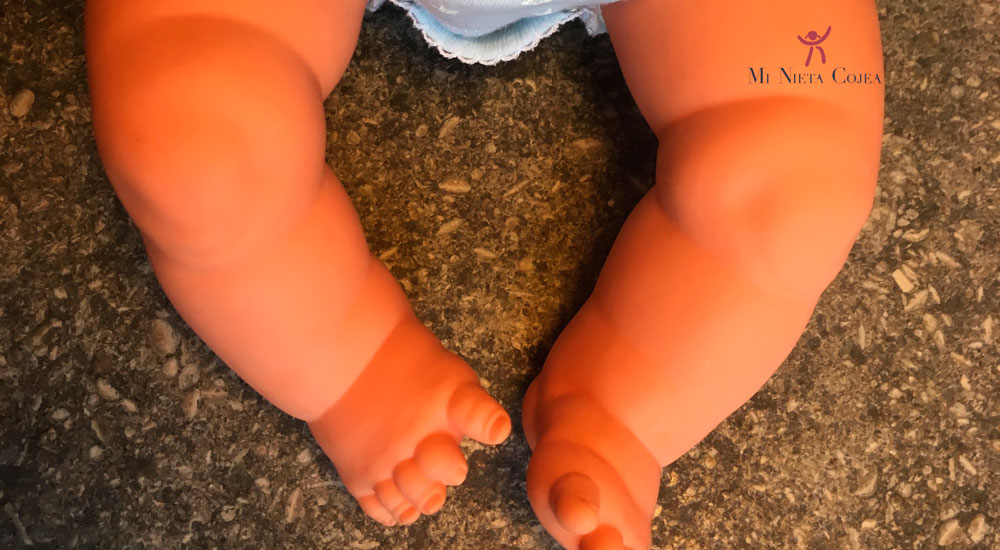 Torsión tibial interna - Juan Cabello