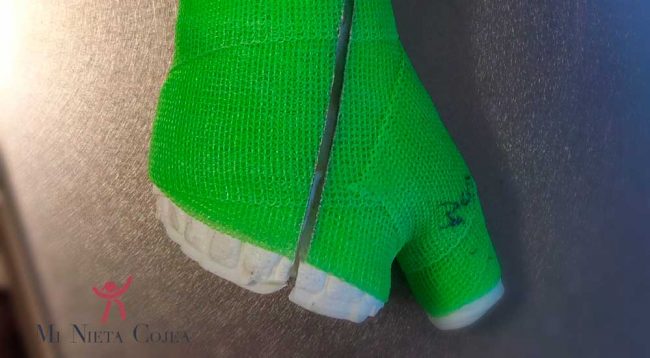 rehabilitacion-antebrazo-fractura-yeso-escayola-fibra-vidrio-resina-waterproof-traumatologia-infantil-juan-cabello