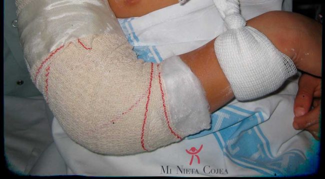 rehabilitacion-codo-ferula-yeso-escayola-traumatologo-infantil-juan-cabello