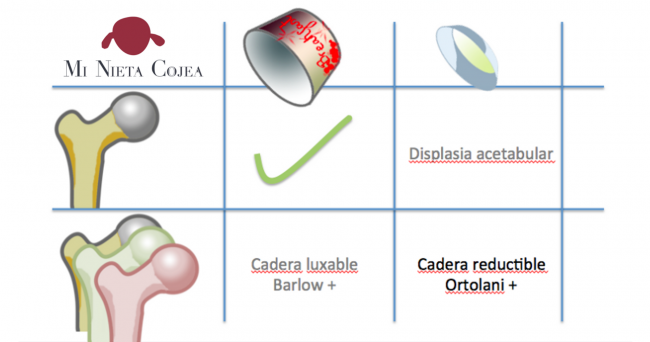 Espectro displasia cadera