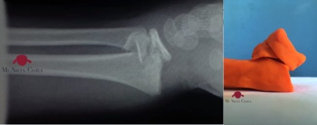 portada-epifisiolisis-minietacojea