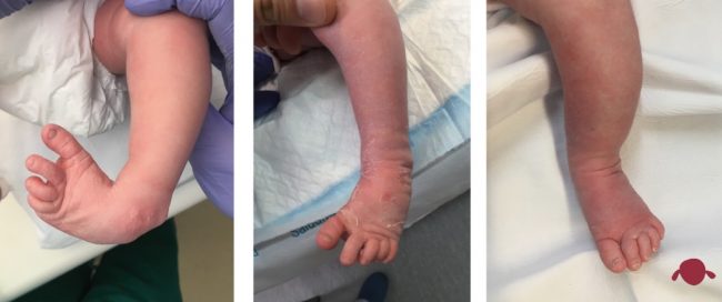 portada-pie-zambo-talipes-equinovaro-pie-bot