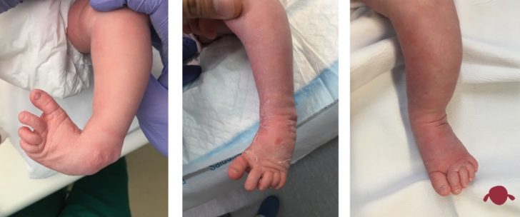 portada-pie-zambo-talipes-equinovaro-pie-bot