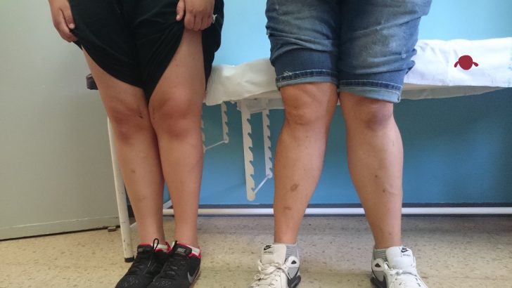 portada-genu-valgo-corregido-y-sin-corregir